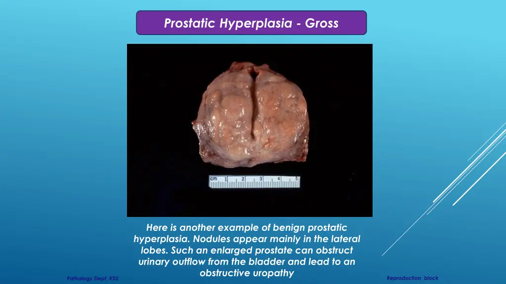 prostatic hyperplasia gross 1