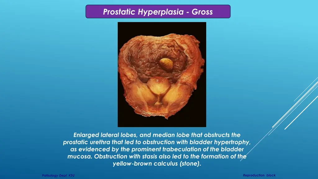 prostatic hyperplasia gross