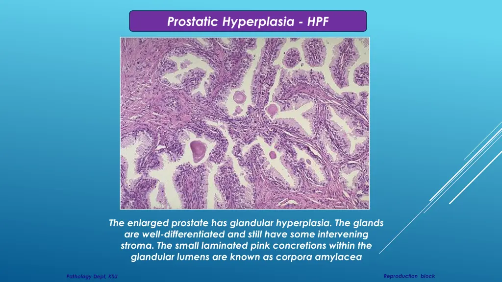 prostatic hyperplasia hpf