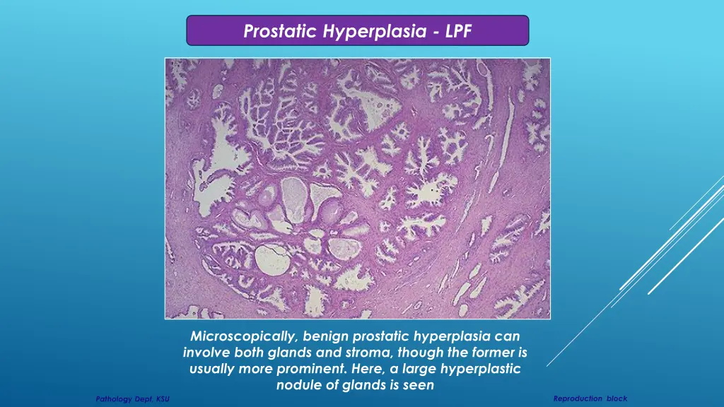 prostatic hyperplasia lpf