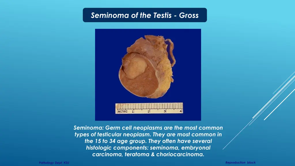 seminoma of the testis gross 1