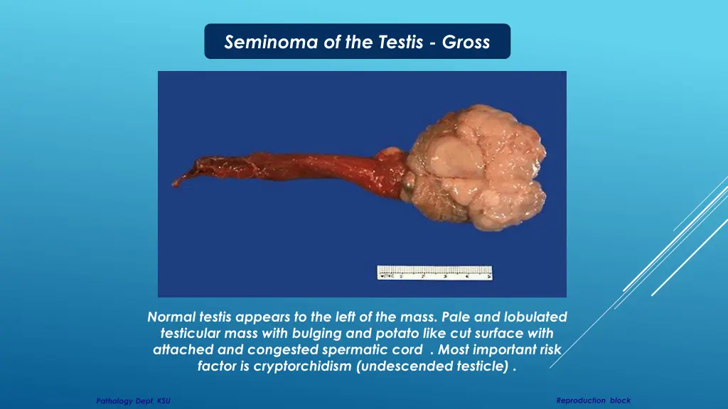 seminoma of the testis gross