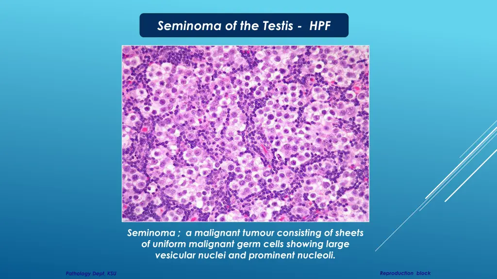 seminoma of the testis hpf