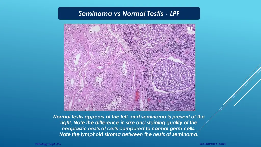 seminoma vs normal testis lpf