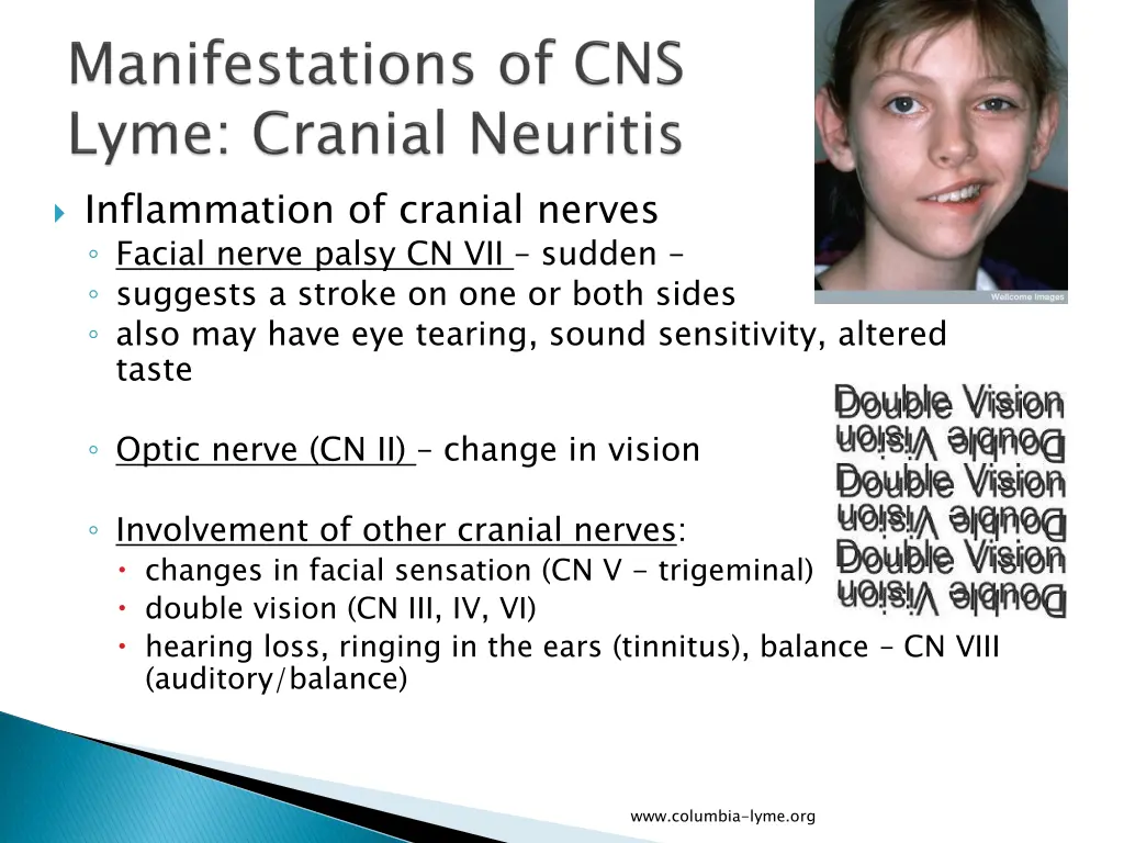 inflammation of cranial nerves facial nerve palsy