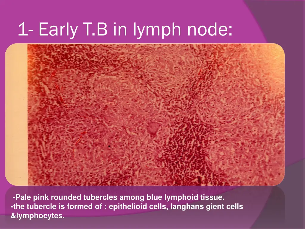 1 early t b in lymph node