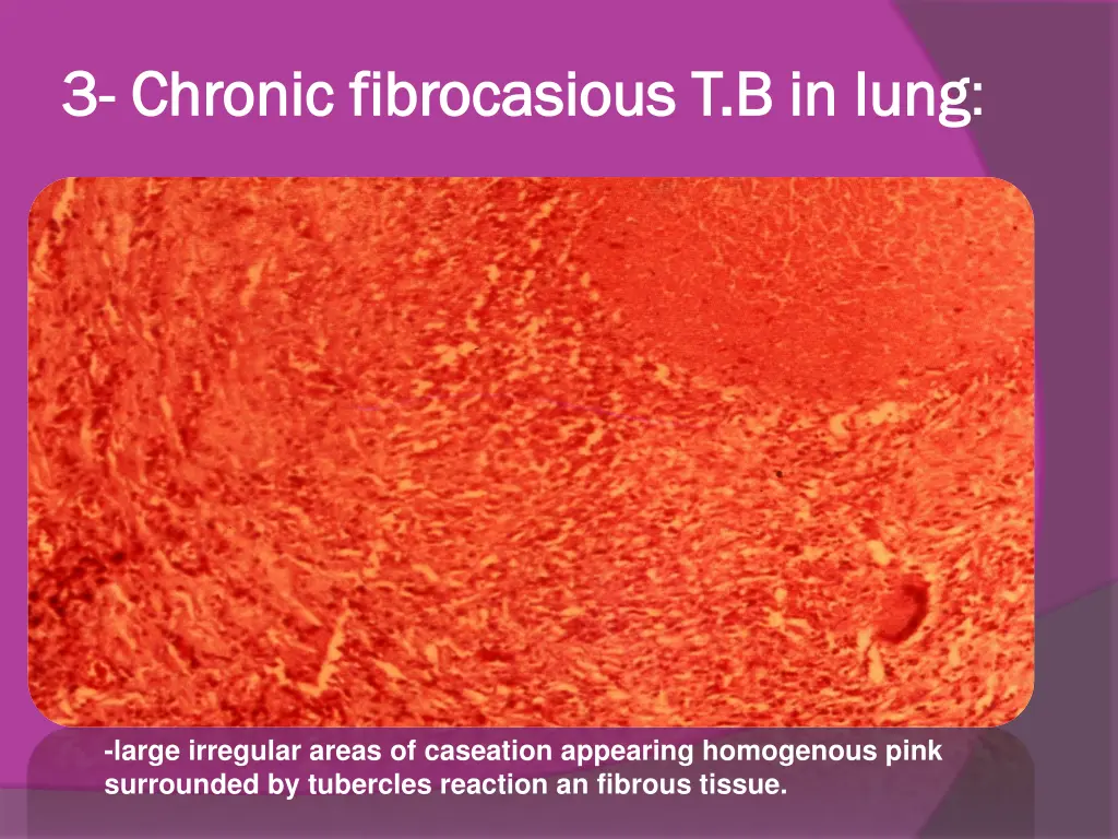 3 3 chronic chronic fibrocasious fibrocasious