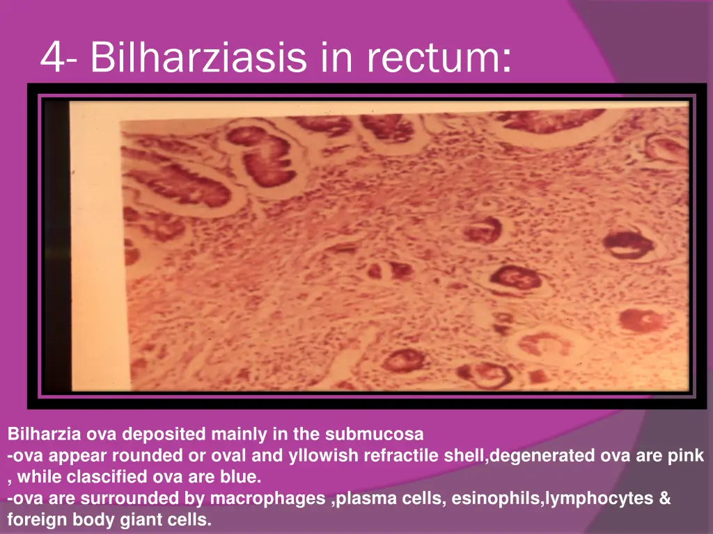 4 bilharziasis in rectum