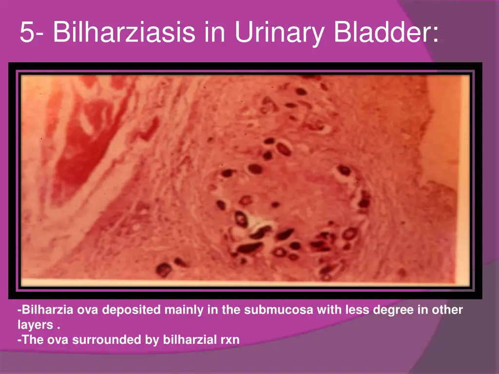 5 bilharziasis in urinary bladder