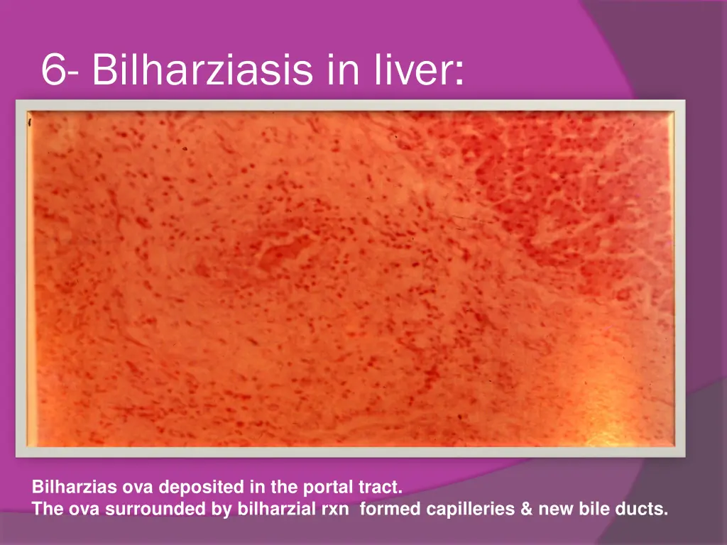 6 bilharziasis in liver