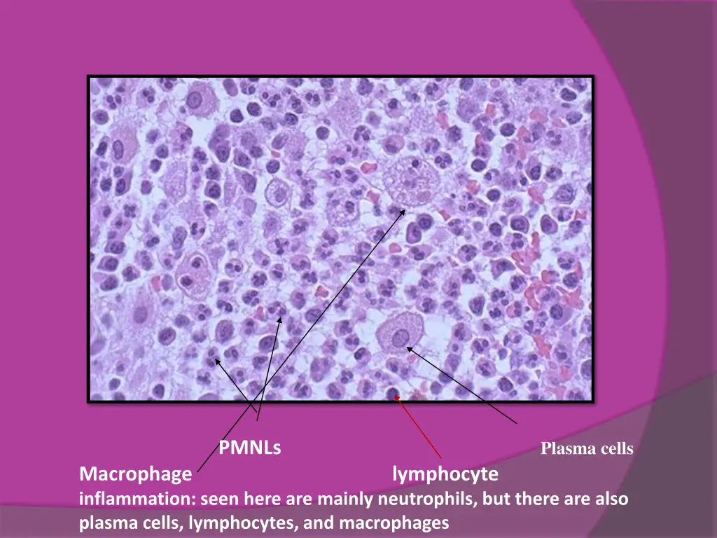 pmnls plasma cells macrophage inflammation seen