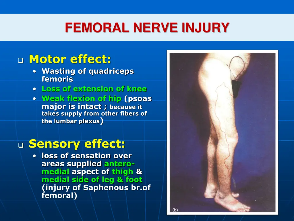 femoral nerve injury