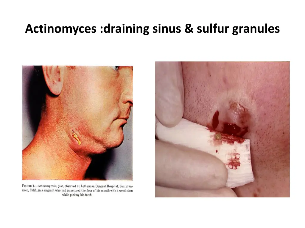 actinomyces draining sinus sulfur granules