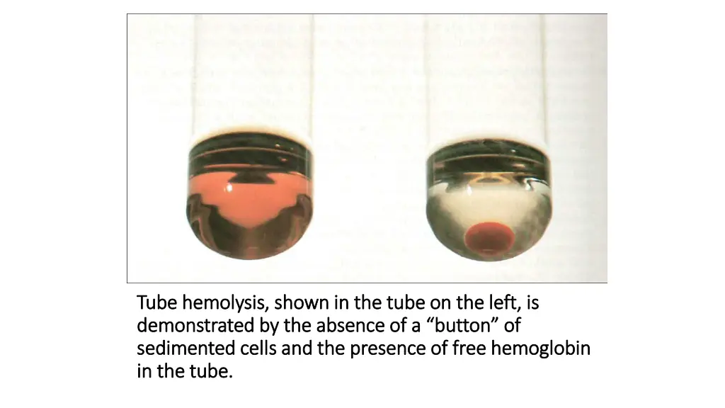 tube hemolysis shown in the tube on the left