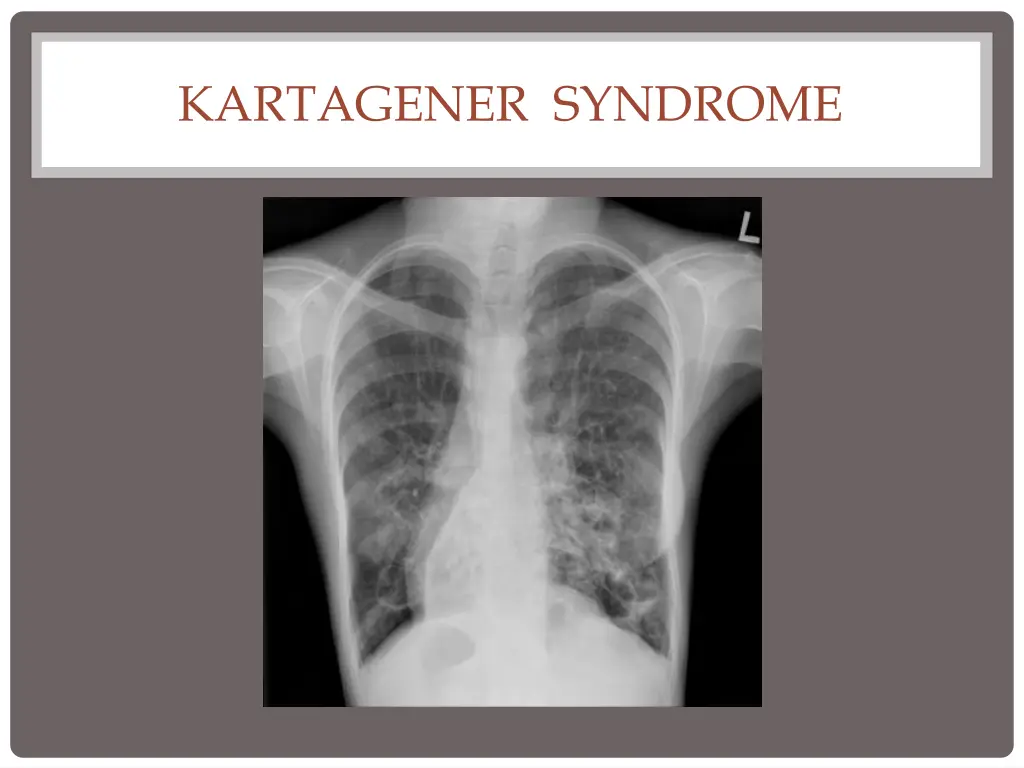 kartagener syndrome 2