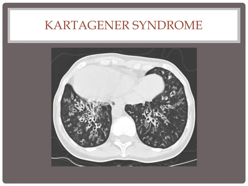 kartagener syndrome 3