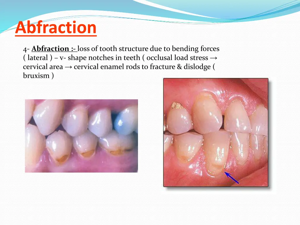 abfraction