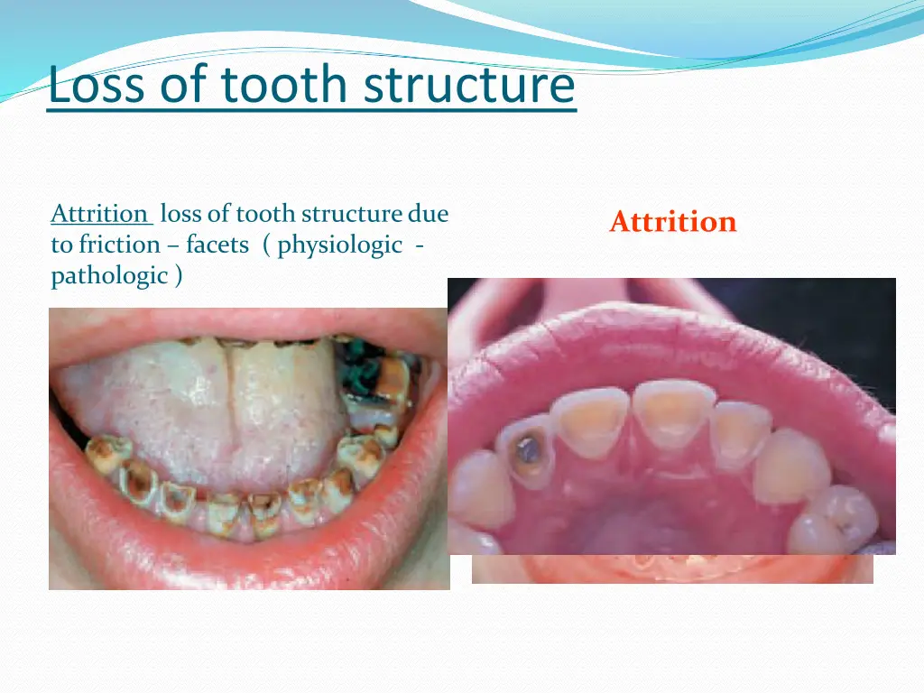 loss of tooth structure