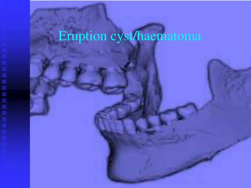 eruption cyst haematoma