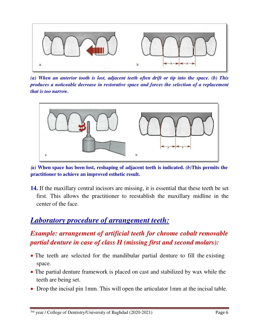 a when an anterior tooth is lost adjacent teeth