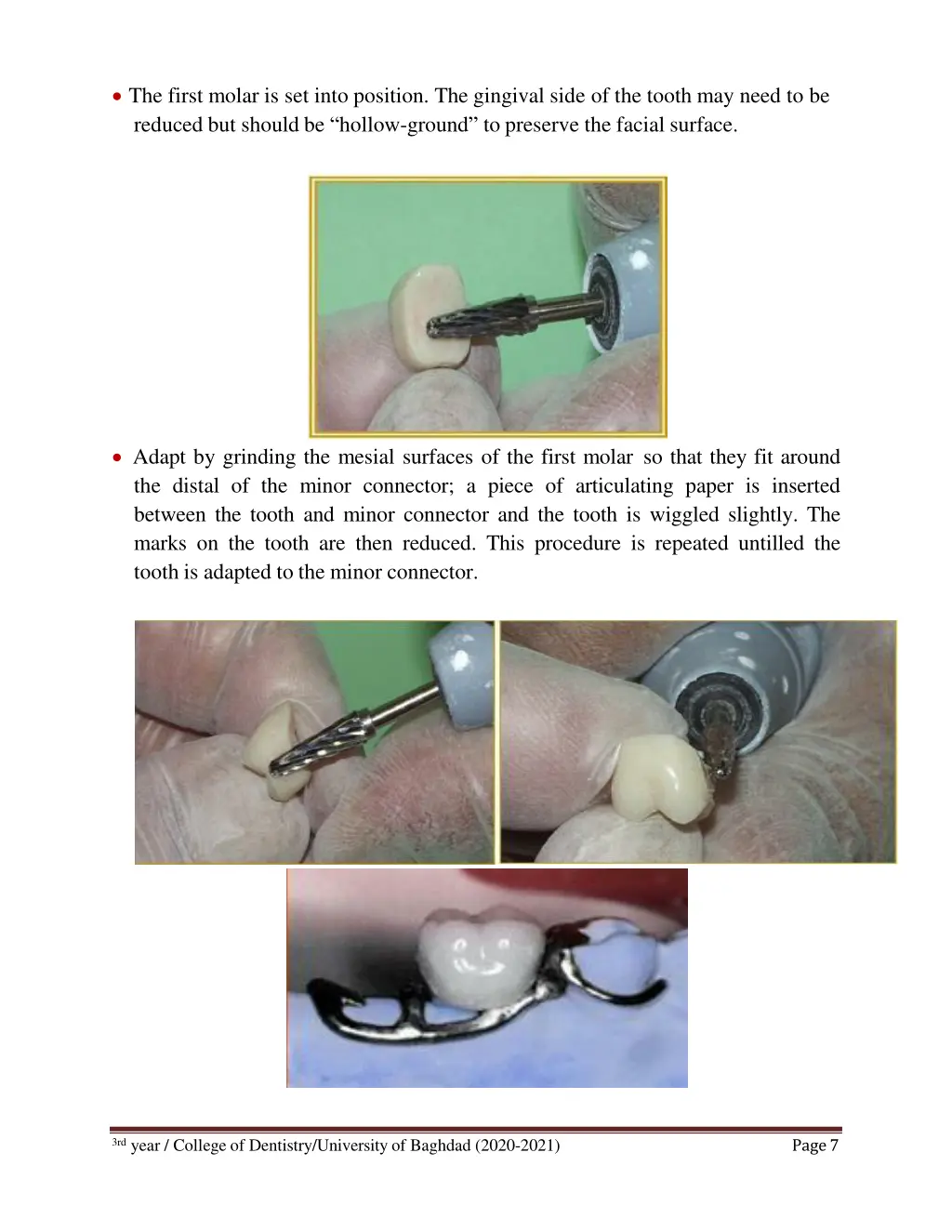 the first molar is set into position the gingival