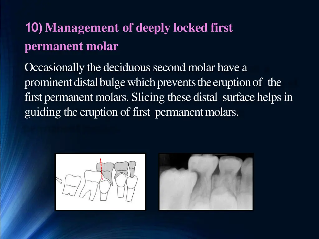 10 management of deeply locked first permanent