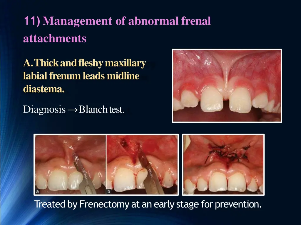 11 management of abnormal frenal attachments