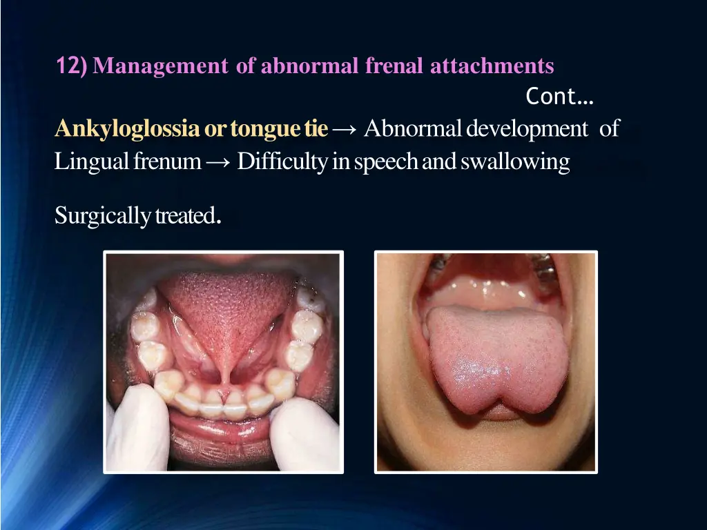 12 management of abnormal frenal attachments