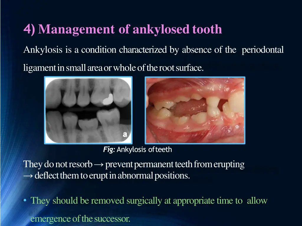 4 management of ankylosedtooth