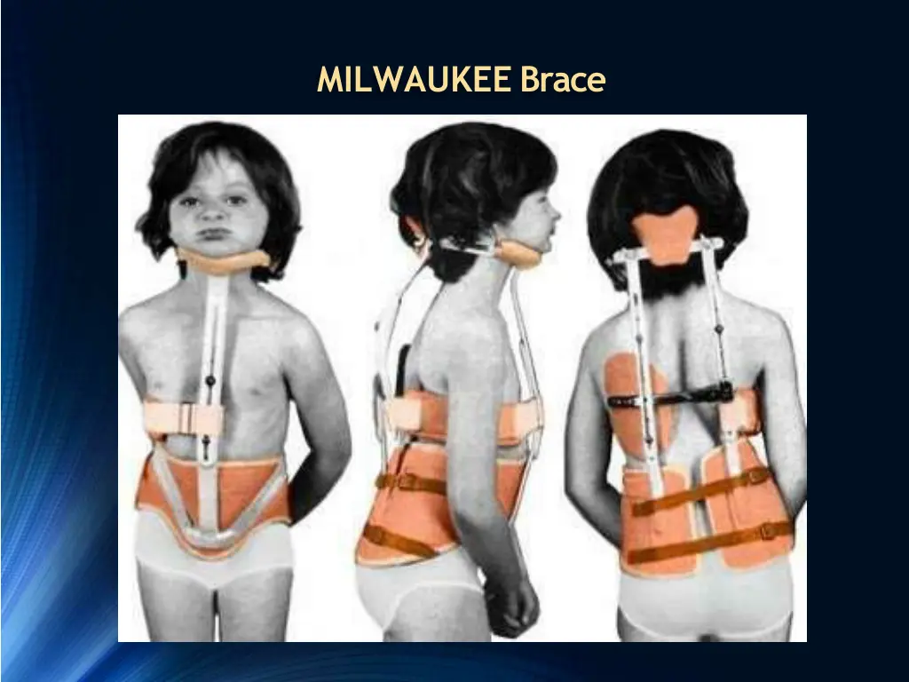 milwaukee brace