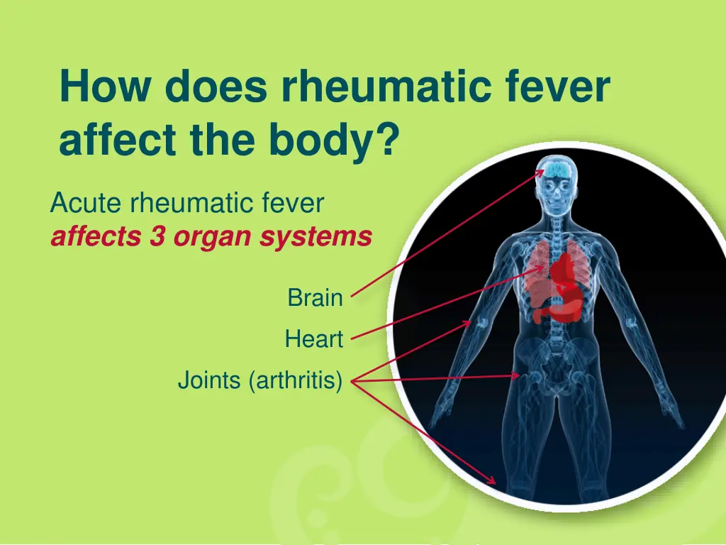 how does rheumatic fever affect the body