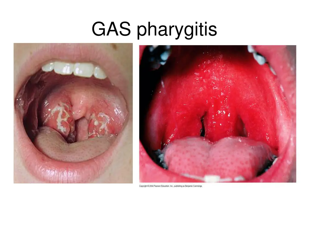 gas pharygitis