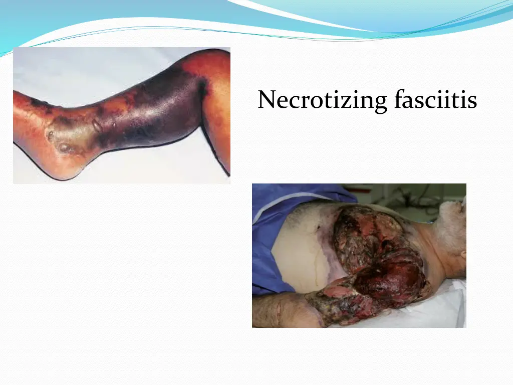 necrotizing fasciitis