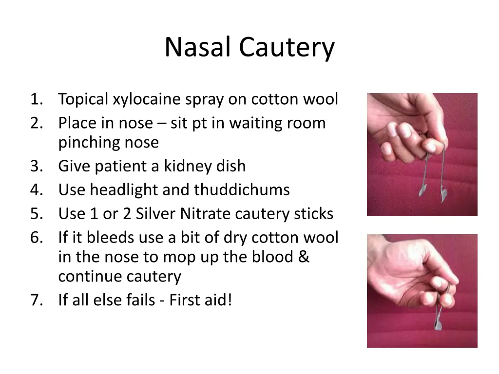 nasal cautery