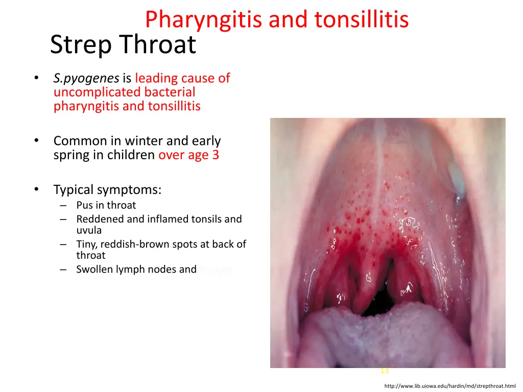 pharyngitis and tonsillitis