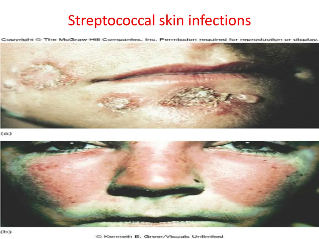 streptococcal skin infections