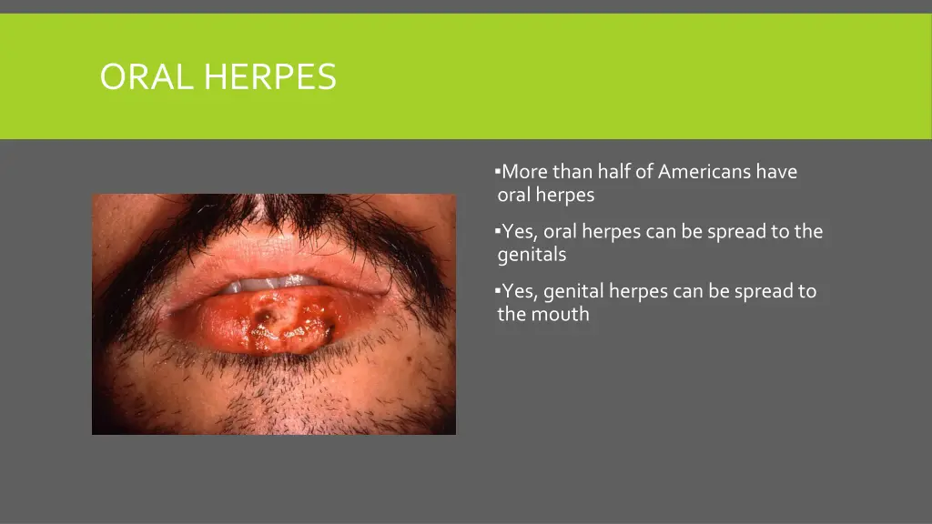 oral herpes