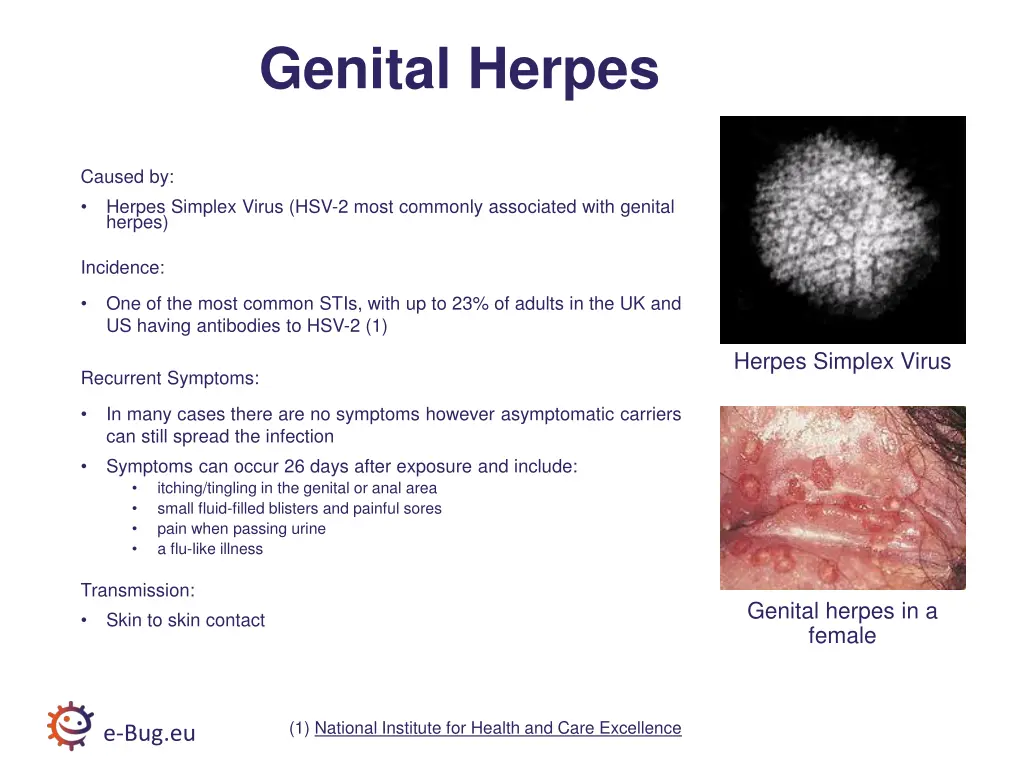 genital herpes