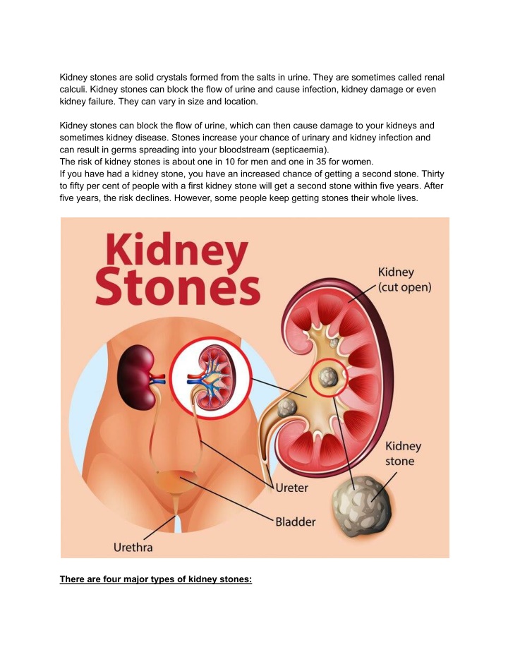 kidney stones are solid crystals formed from