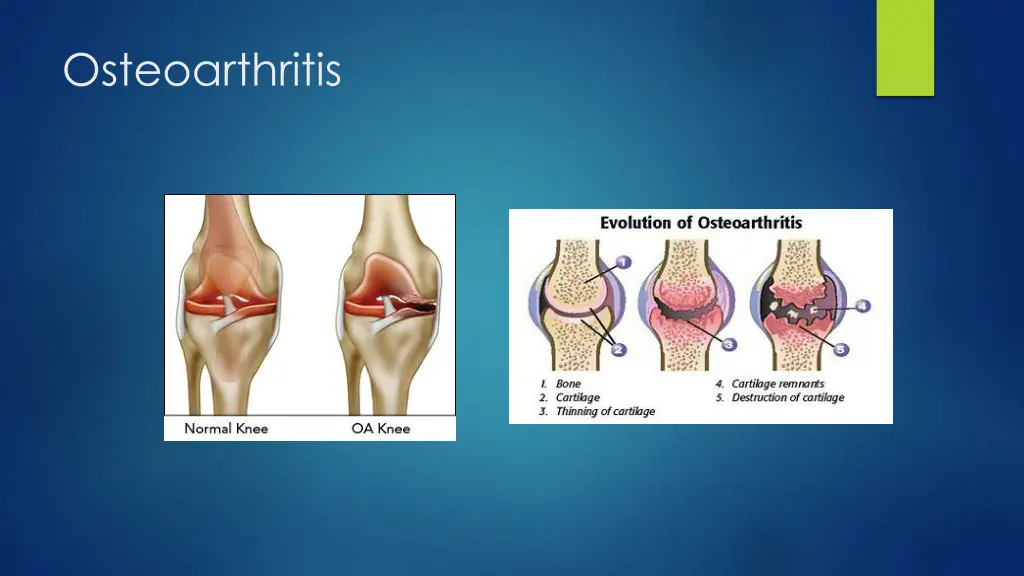 osteoarthritis 1