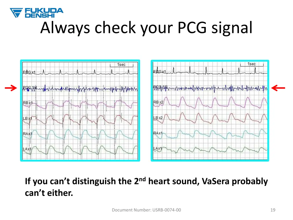 always check your pcg signal