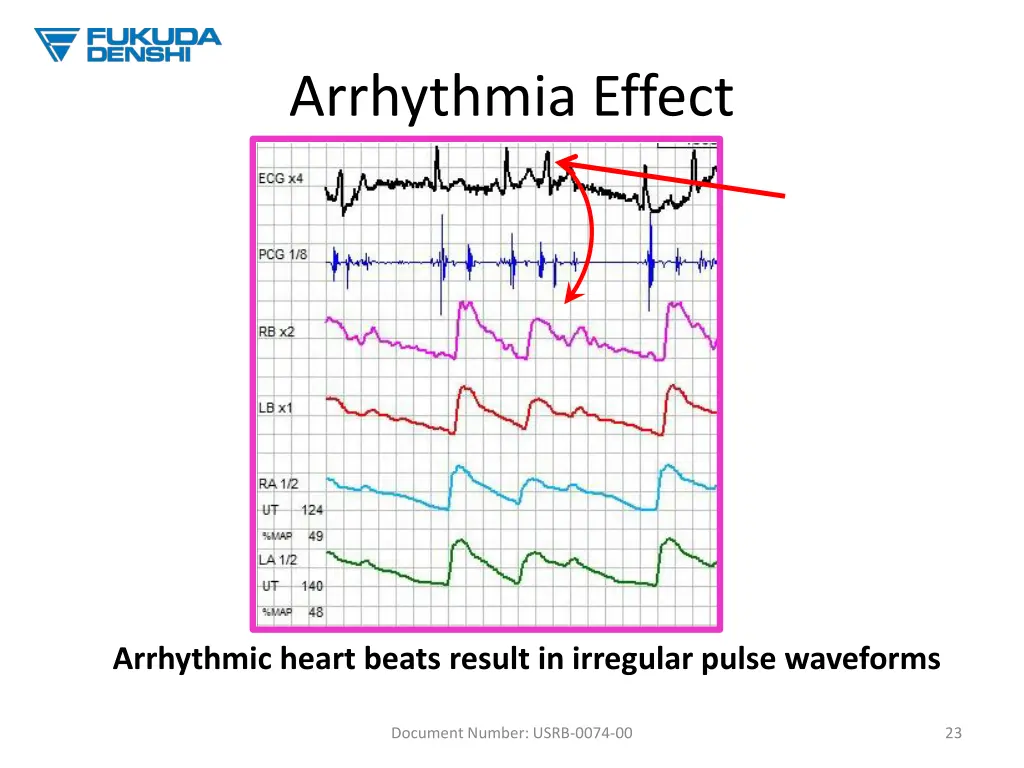 arrhythmia effect