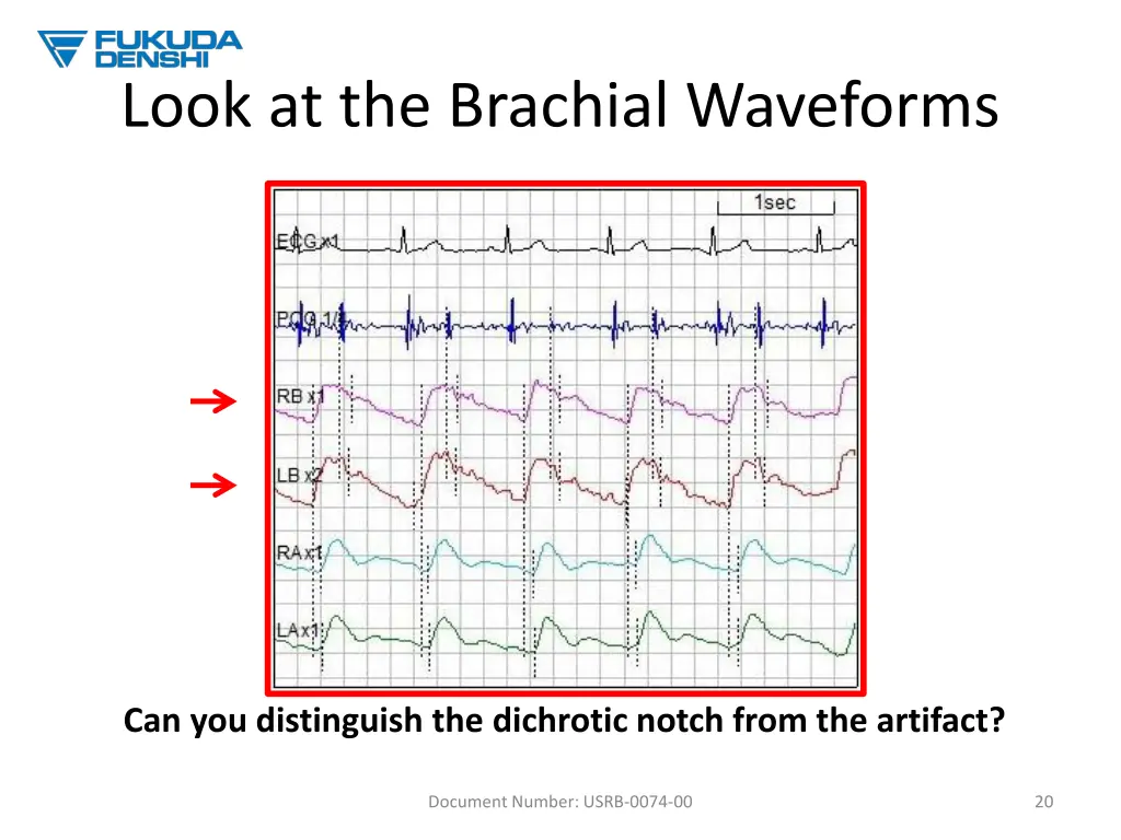 look at the brachial waveforms