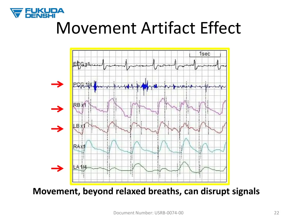 movement artifact effect