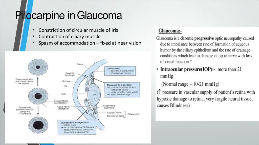 pilocarpine inglaucoma