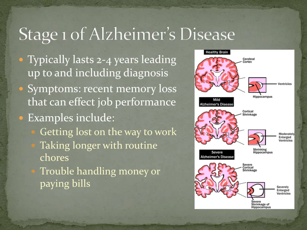 stage 1 of alzheimer s disease