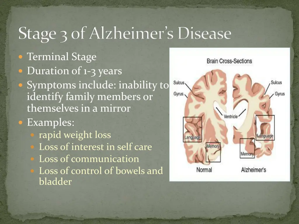 stage 3 of alzheimer s disease