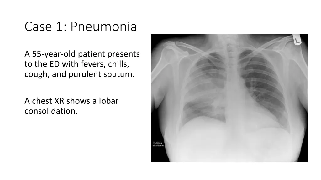 case 1 pneumonia 1