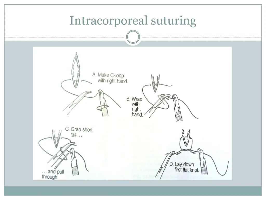 intracorporeal suturing