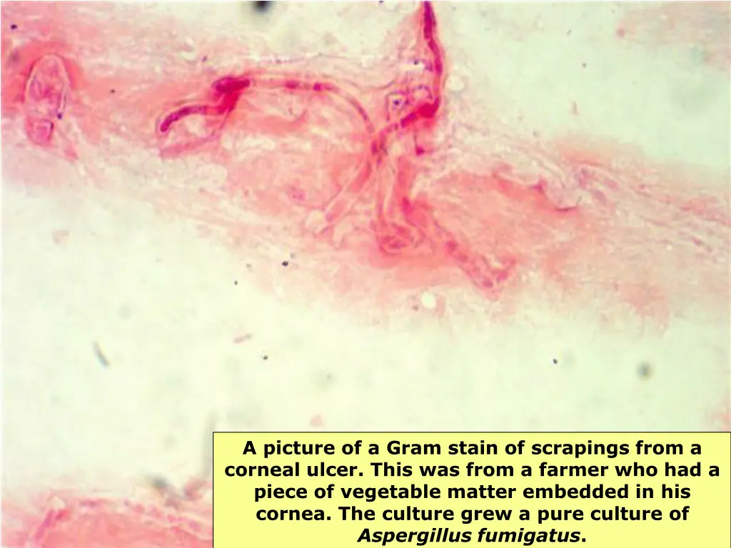 a picture of a gram stain of scrapings from